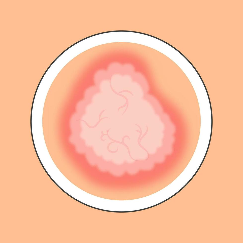 Red And Peach Warts Disease Skin Circle Icon In Flat Style. vector