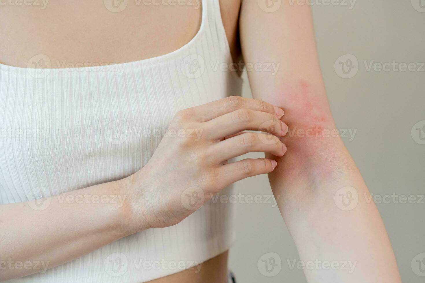 dermatología asiático joven mujer, niña alergia, alérgico reacción desde atópico, insecto picaduras en su brazo, mano en rascarse que produce picor, picar rojo Mancha o erupción de piel. cuidado de la salud, tratamiento de belleza. foto