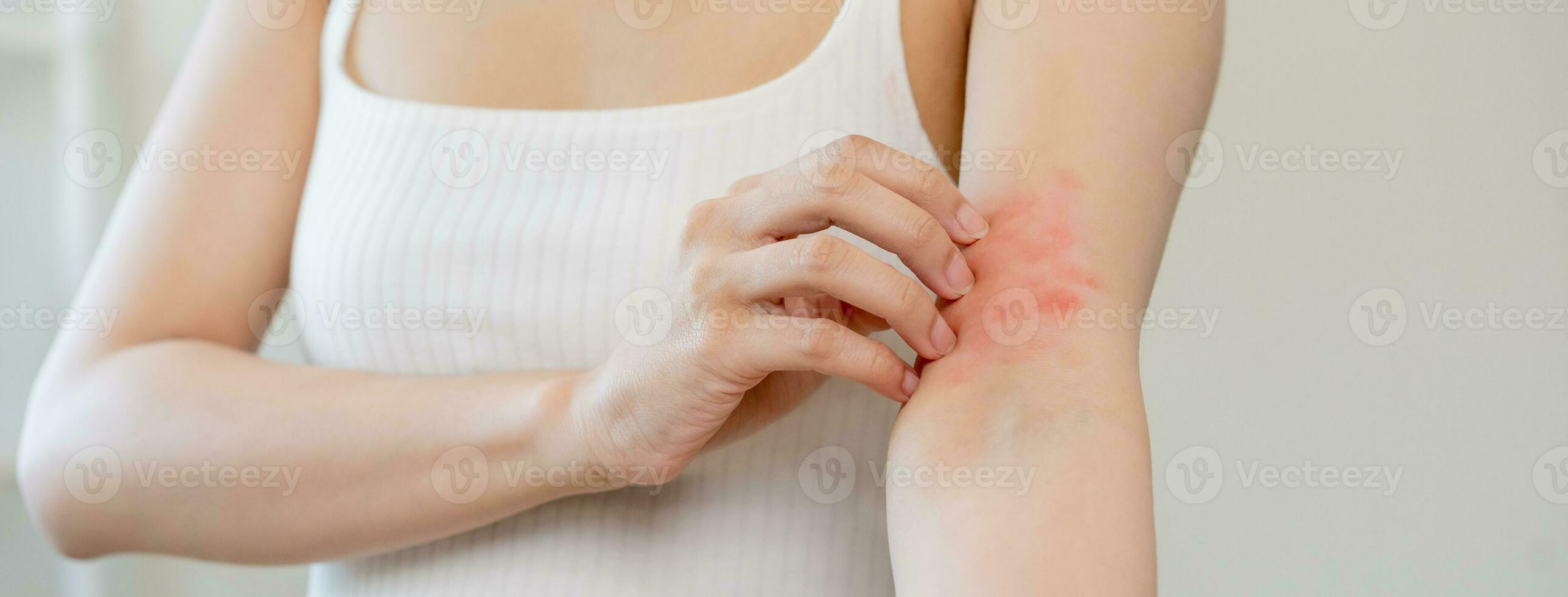 dermatología asiático joven mujer, niña alergia, alérgico reacción desde atópico, insecto picaduras en su brazo, mano en rascarse que produce picor, picar rojo Mancha o erupción de piel. cuidado de la salud, tratamiento de belleza. foto