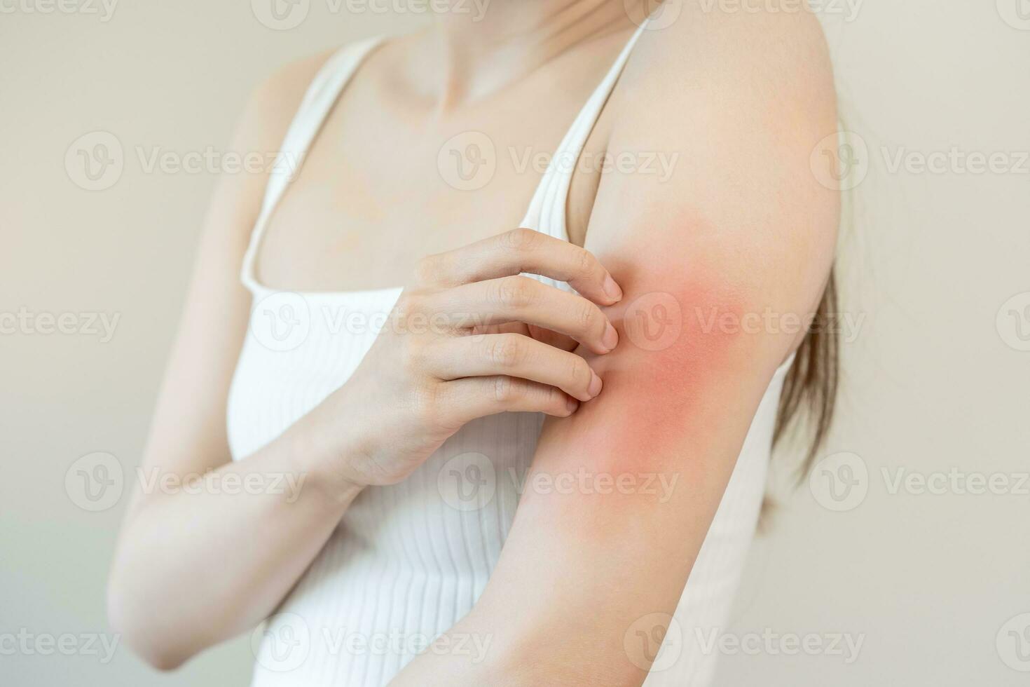 Dermatology asian young woman, girl allergy, allergic reaction from atopic, insect bites on her arm, hand in scratching itchy, itch red spot or rash of skin. Healthcare, treatment of beauty. photo