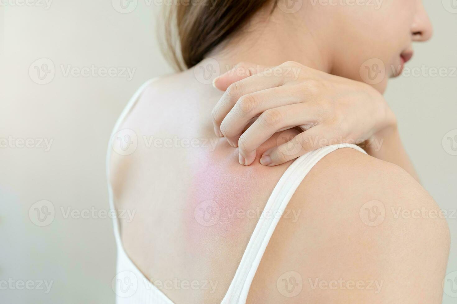 Dermatology, asian young woman, girl allergy, allergic reaction from atopic, insect bites on her back, hand in scratching itchy, itch red spot or rash of skin. Healthcare, treatment of beauty. photo