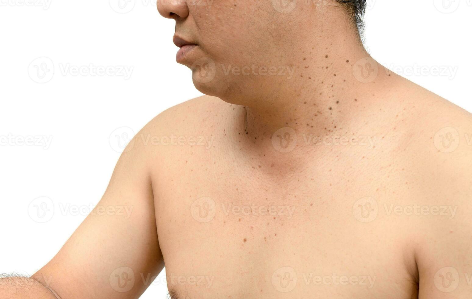 skin tags or Seborrheic Keratosis on neck photo