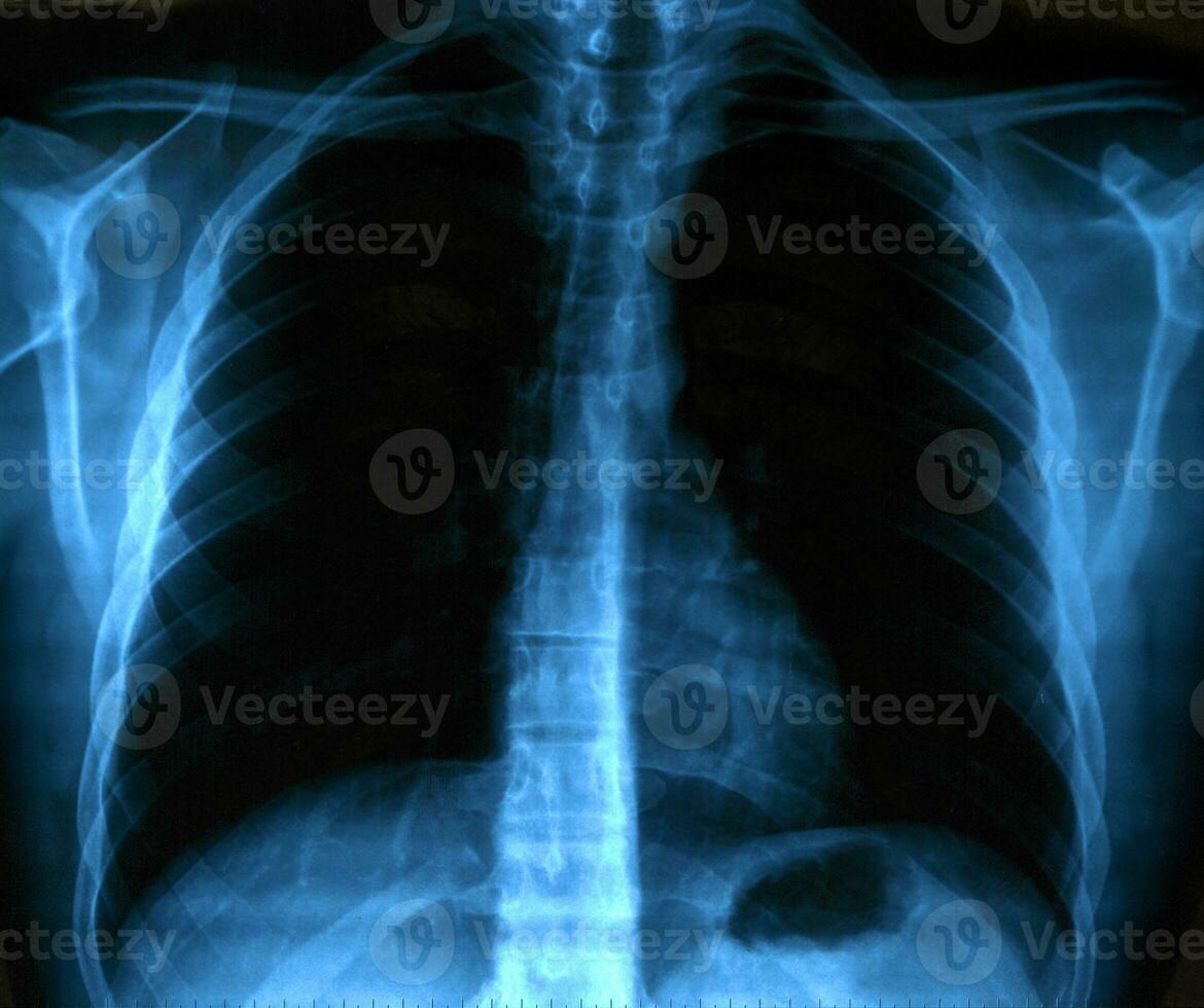 X-Ray Image Of Human Healthy Chest photo