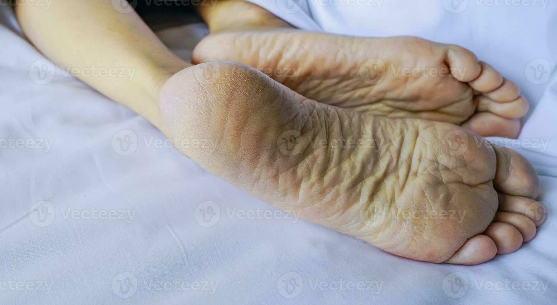 Close-up cracked heel. Dry foot care needs skincare for foot. Women sleep barefoot on a white comfort bed in hotel or home bedroom. Lazy Sunday morning. Cracked heel needs foot spa and pedicure. photo