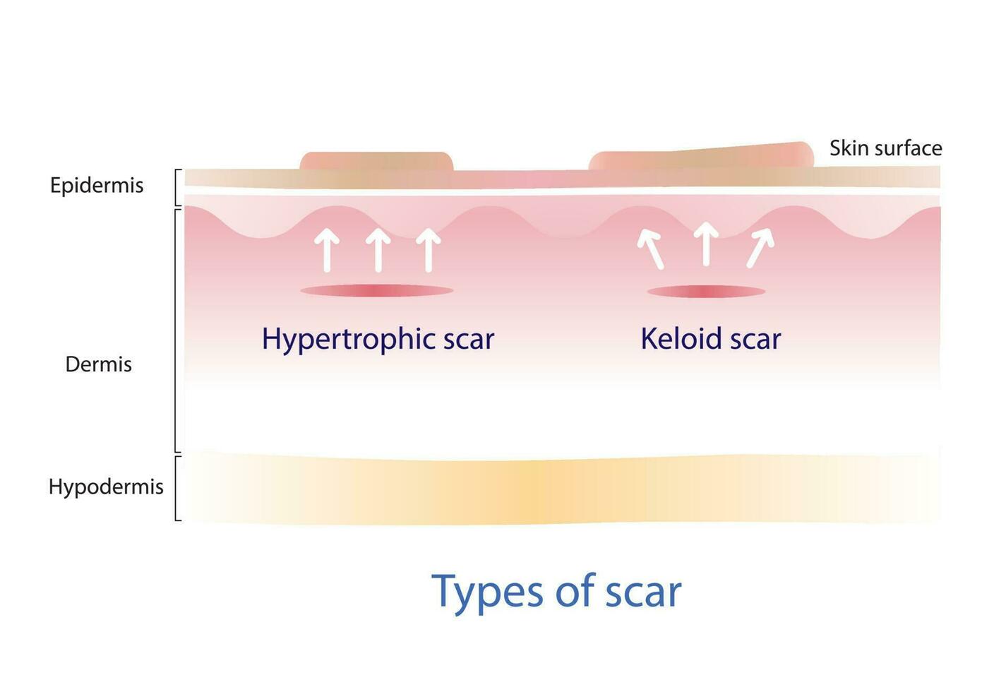 Type of keloid scar and hypertrophic scar on skin surface. Scars are caused by wounds that reach the dermis layer. vector