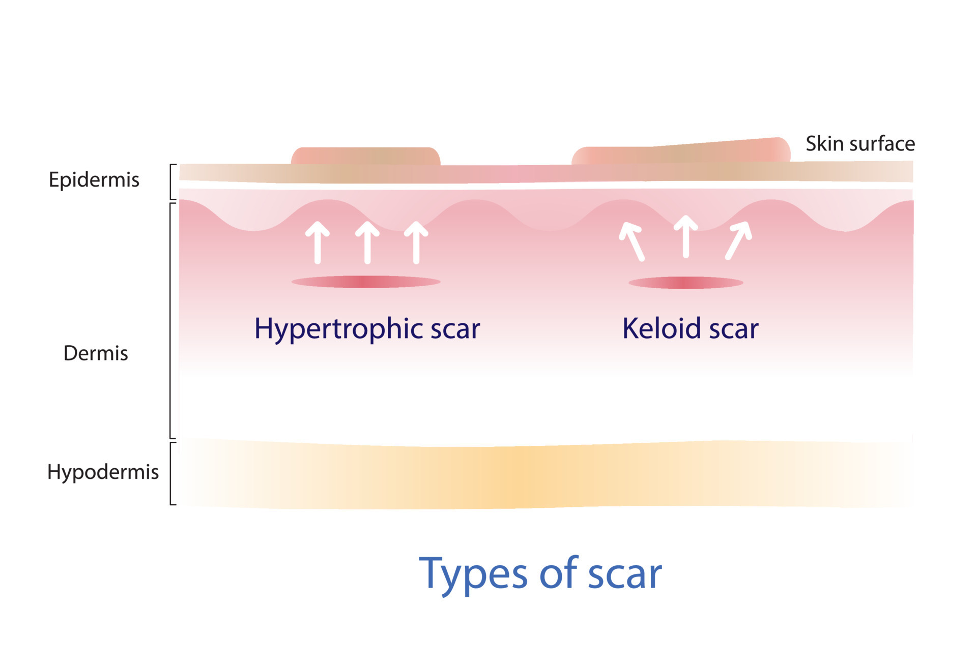 Type of keloid scar and hypertrophic scar on skin surface. Scars are