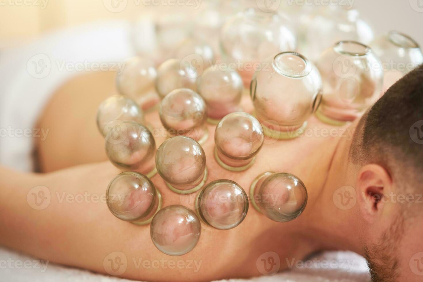 A picture of a man having cupping therapy photo