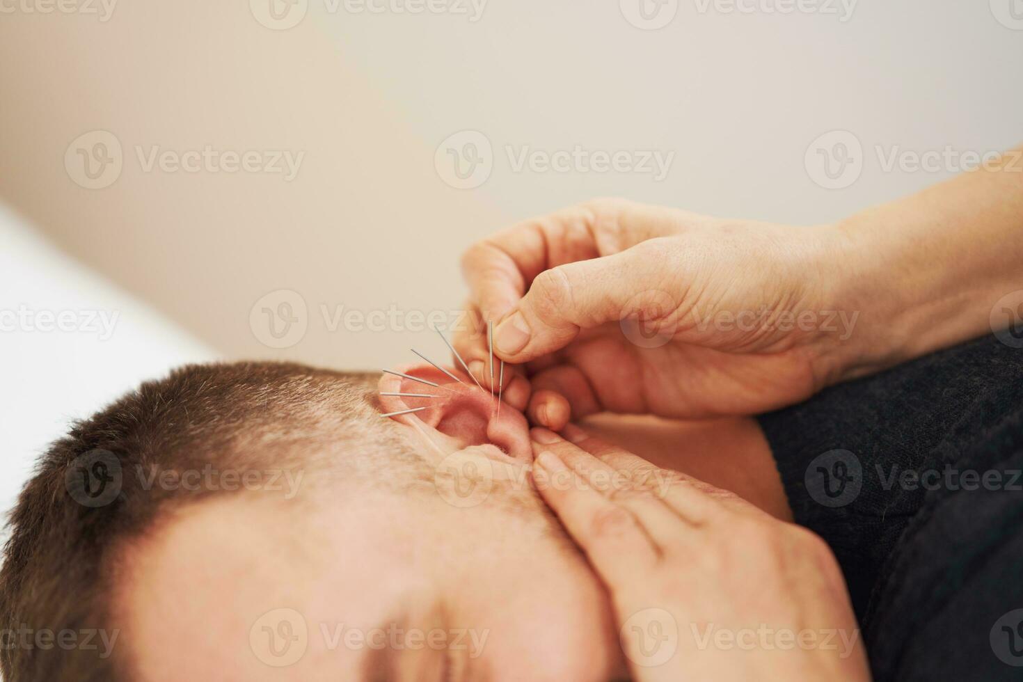 un imagen de un hombre teniendo acupuntura en oído foto