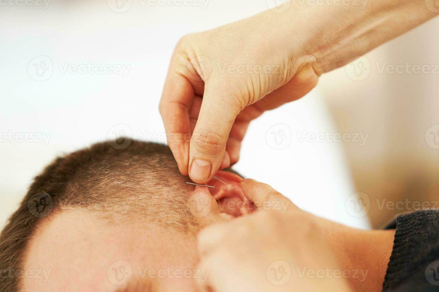 A picture of a man having acupuncture on ear photo