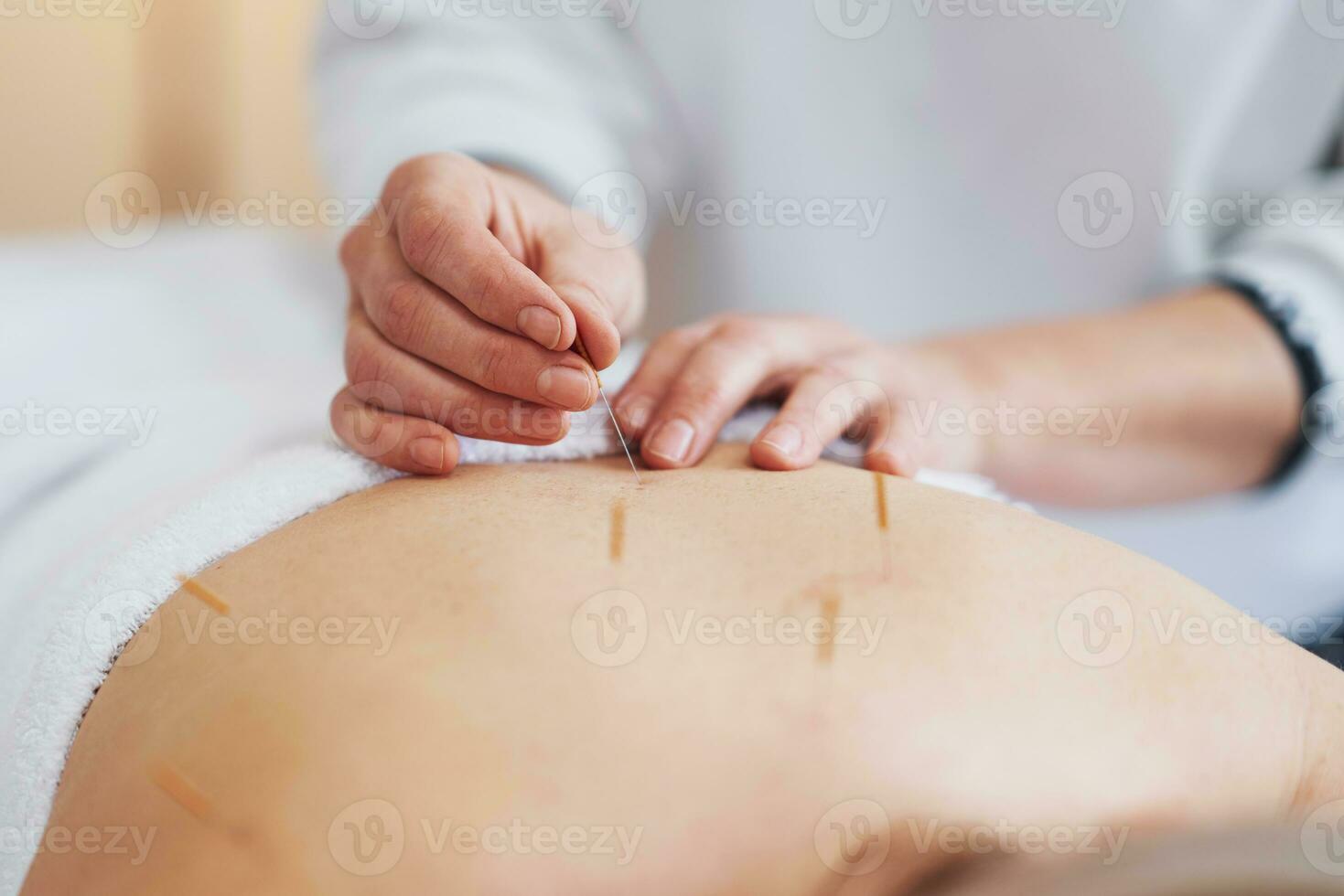un acupuntura aguja terapia en el estudio foto