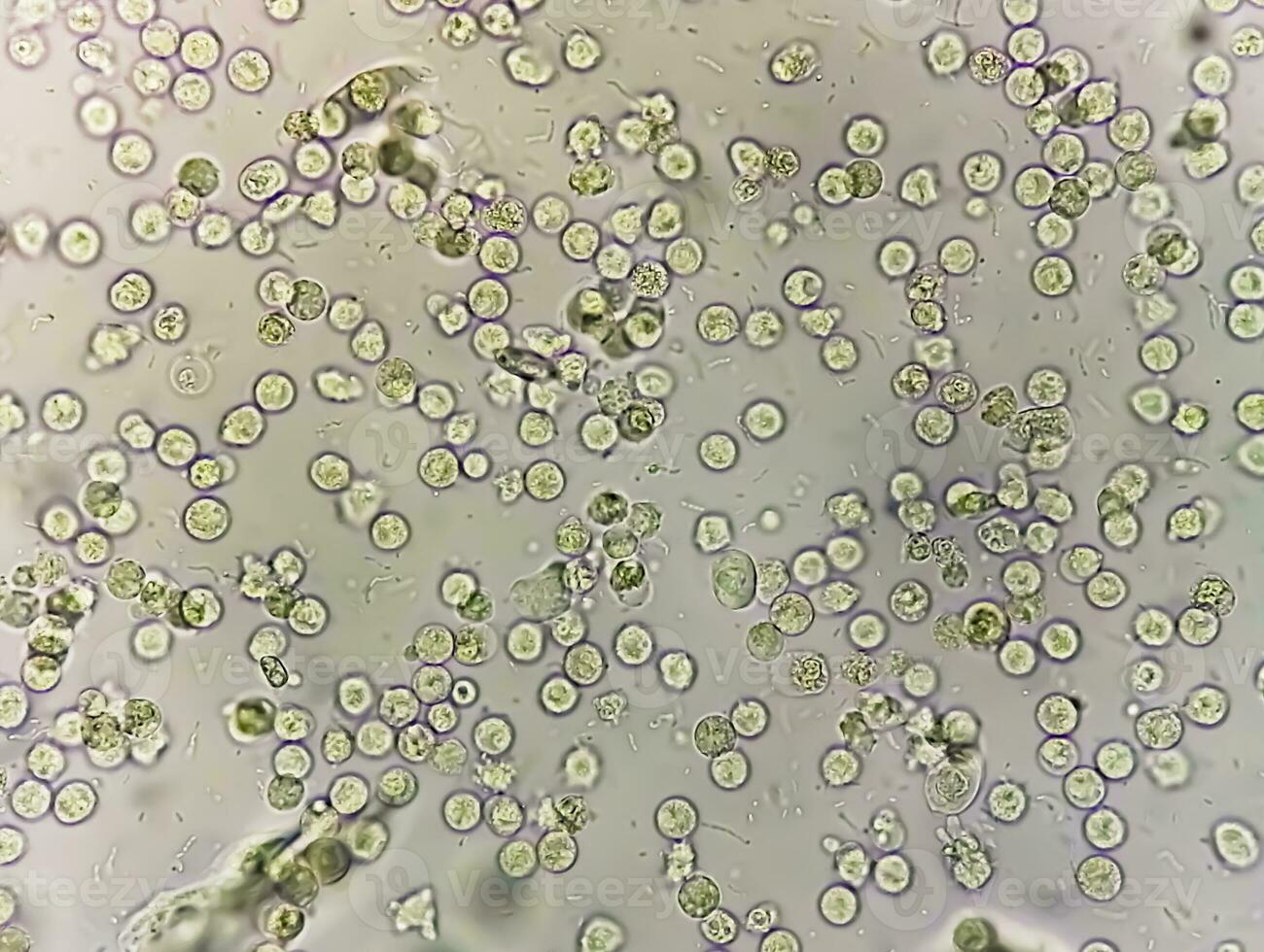 Pyuria or leukocyturia is the condition of urine containing white blood cells or pus. It can be a sign of a bacterial urinary tract infection photo