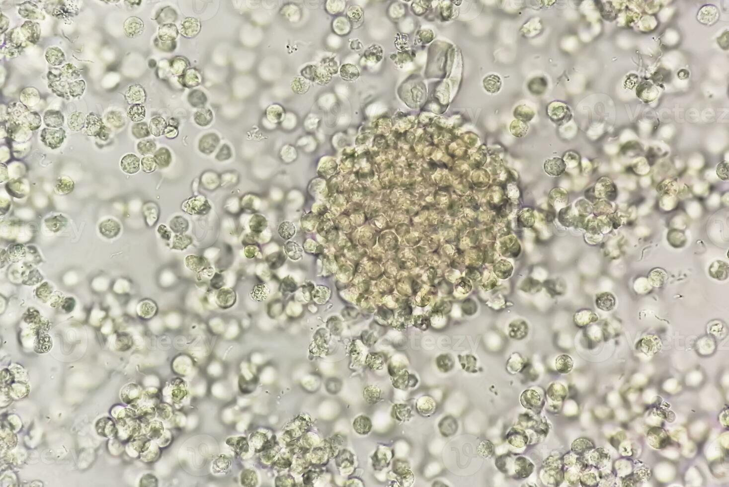 Pyuria or leukocyturia is the condition of urine containing white blood cells or pus. It can be a sign of a bacterial urinary tract infection photo