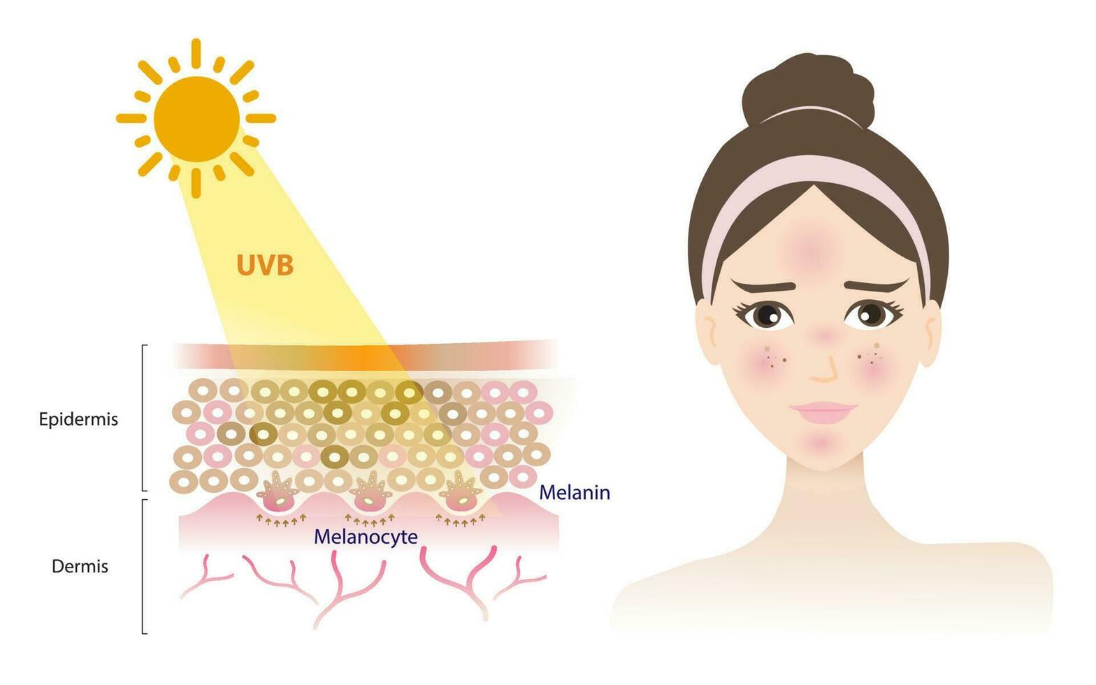UVB rays penetrate into the epidermis skin layer, damage woman face, resulting in a burn, inflammation, aging, wrinkle, red spots vector isolated on white background. Skin care concept illustration.