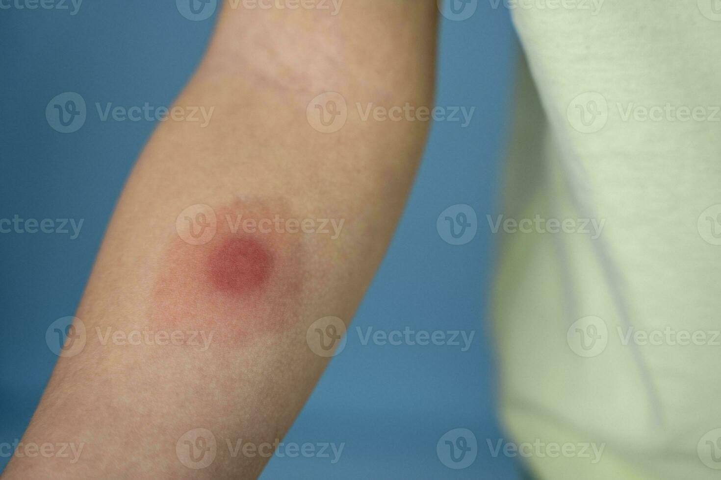 mantoux vaccination, Closeup view photography of kid's arm with red spot reaction to conducting Mantoux test photo