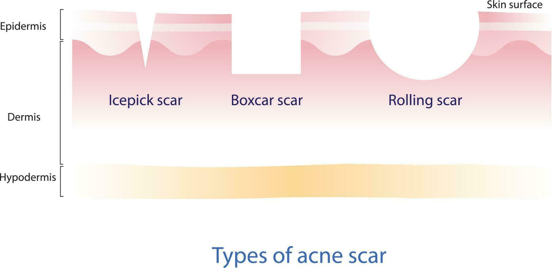 tipos de acné cicatriz vector en blanco antecedentes. cruzar sección de picahielo cicatriz, furgón cicatriz y laminación cicatriz con piel capa. piel cuidado y belleza concepto ilustración.