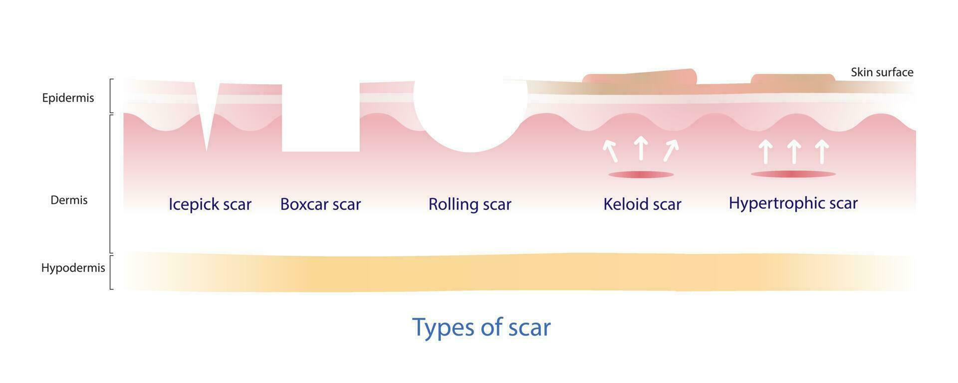 Types of  scar vector, icepick scar, boxcar scar, rolling scar, keloid scar and hypertrophic scar on white background. Skin care and beauty concept illustration. vector