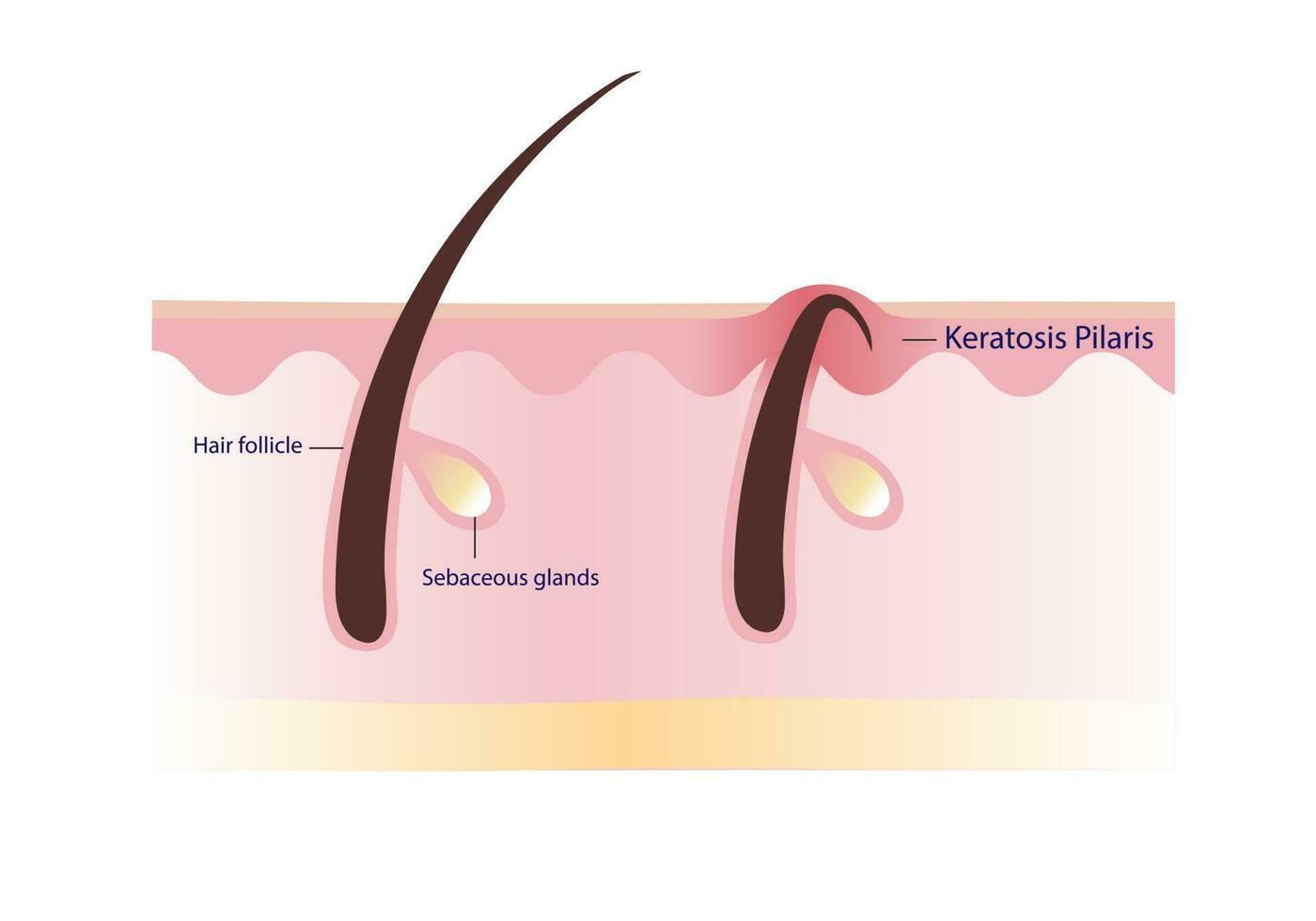 Keratosis Pilaris. Chicken skin vector illustration on white background. Hair has grown back into the skin surface illustration. Atopic Dermatitis Infographic.