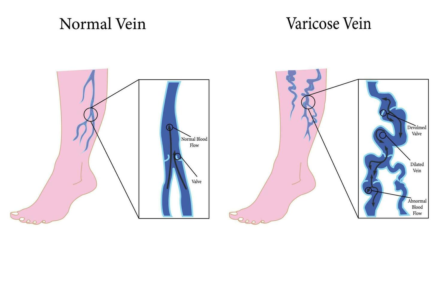 conjunto de varicoso las venas póster. vector plano estilo dibujos animados varicoso ilustración aislado en blanco antecedentes