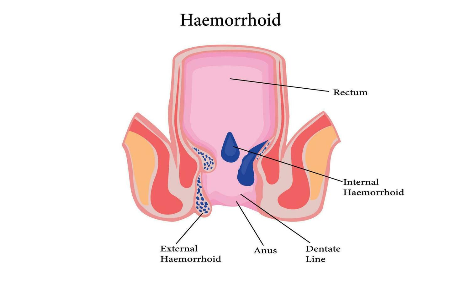 Cross section of the rectum and anal canal. illustration of hemorrhoids structure vector