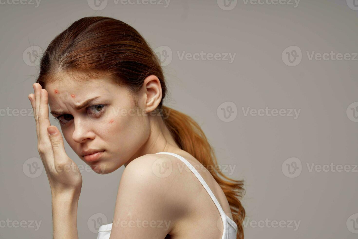 red-haired woman with pimples on the face hygiene light background photo