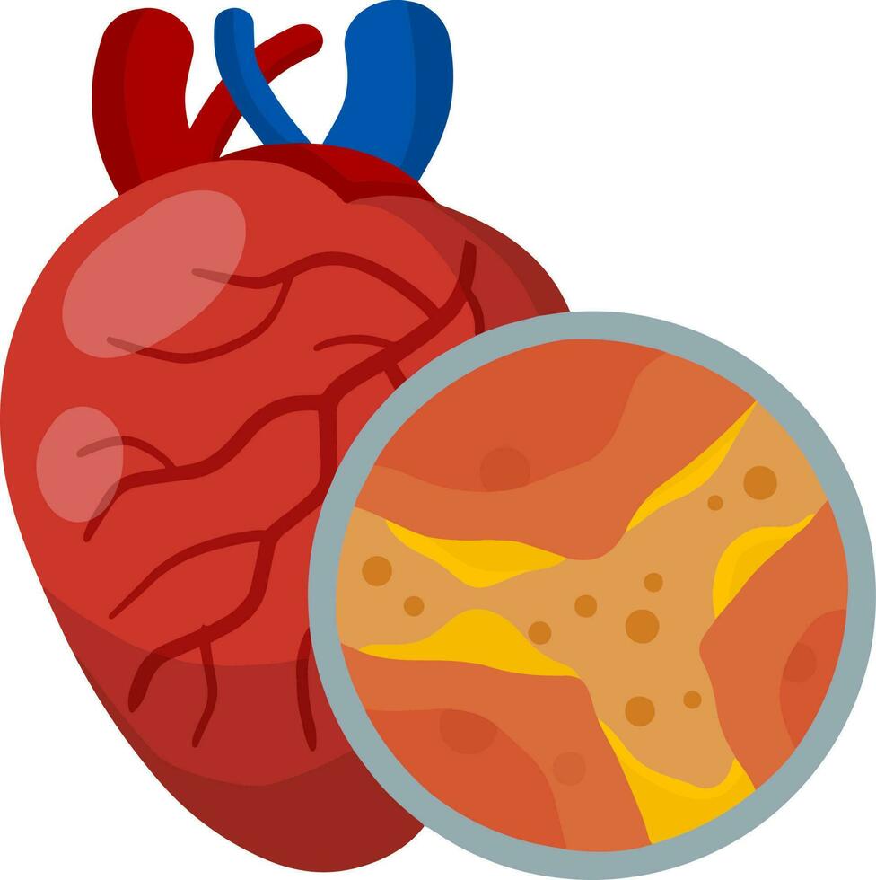 colesterol en vena y arterias corazón y Organo enfermedad. bloqueo y obstrucción de canal. magnificado ver debajo microscopio. salud problema. plano médico educación vector