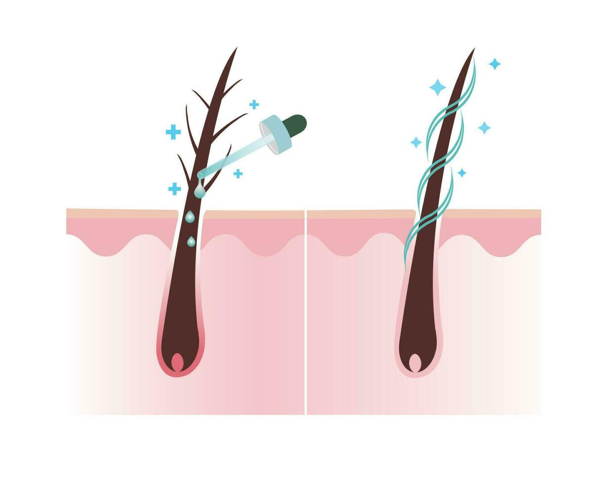 Treat damage hair with treatment and healthy hair scalp layer vector on white background. Hair care concept illustration.