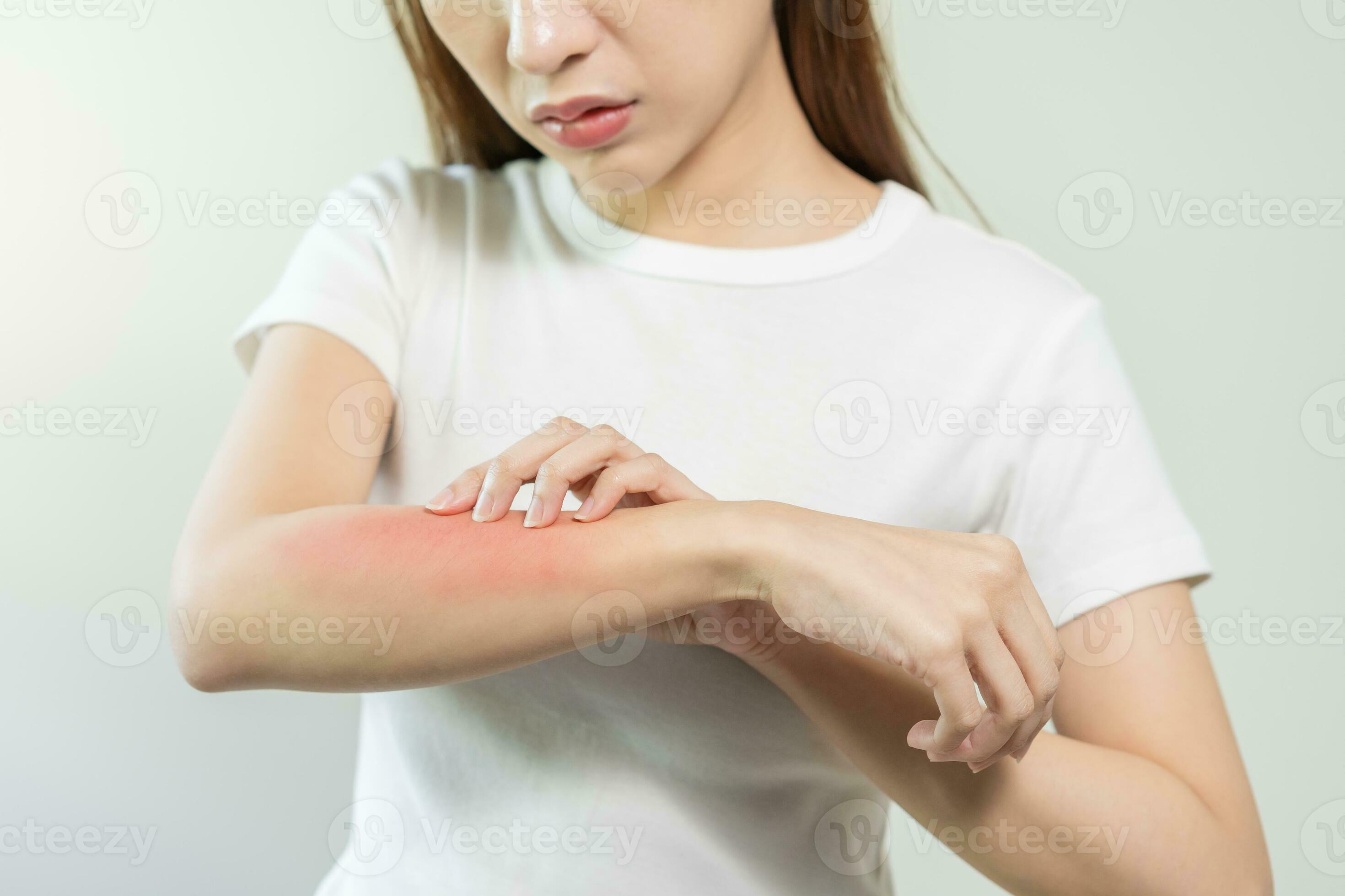 Dermatology asian young woman, girl allergy, allergic reaction from atopic, insect bites on her