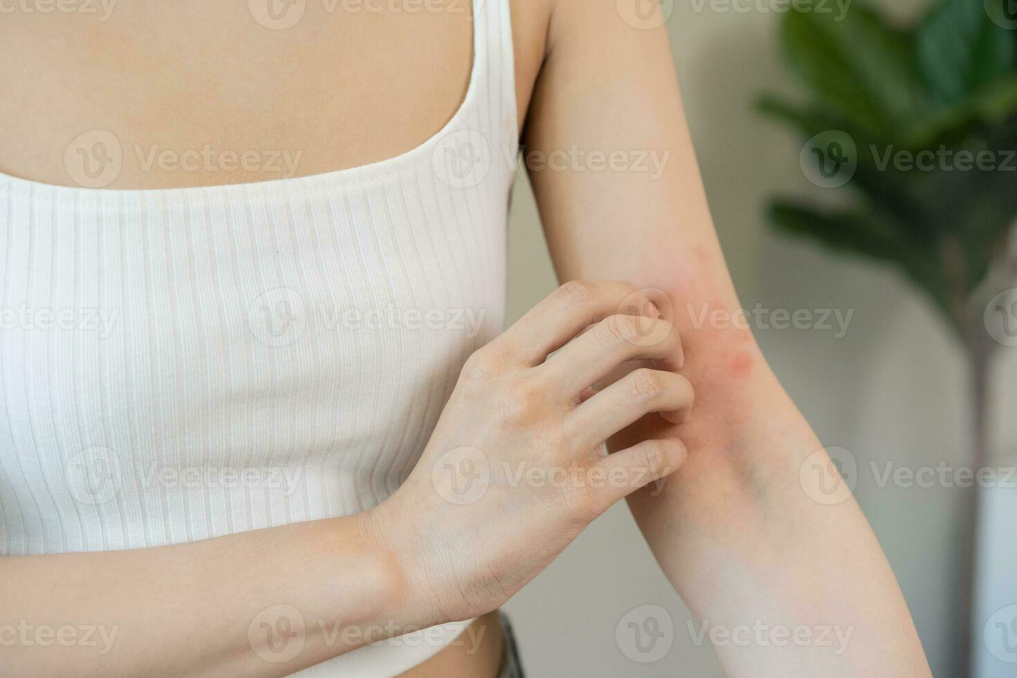 Dermatology asian young woman, girl allergy, allergic reaction from atopic, insect bites on her arm, hand in scratching itchy, itch red spot or rash of skin. Healthcare, treatment of beauty. photo