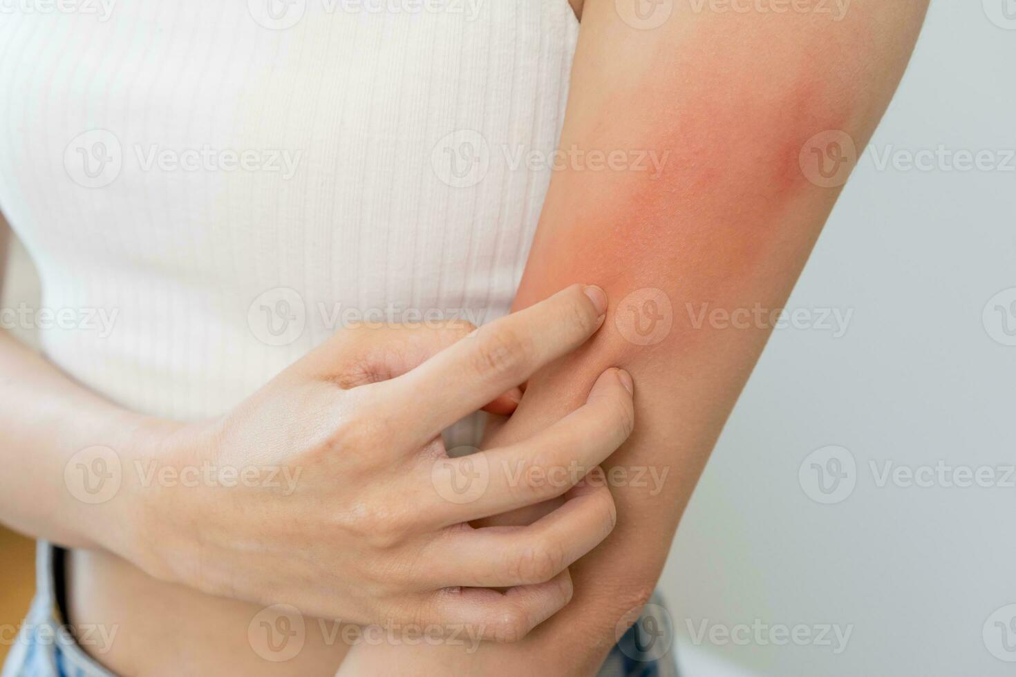 Dermatology asian young woman, girl allergy, allergic reaction from atopic, insect bites on her arm, hand in scratching itchy, itch red spot or rash of skin. Healthcare, treatment of beauty. photo