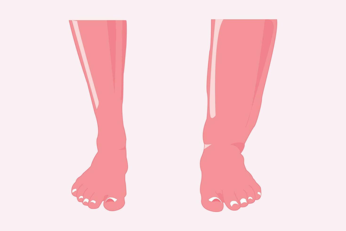 normal and abnormal foot. edema foot illustration for education. eps 10 vector