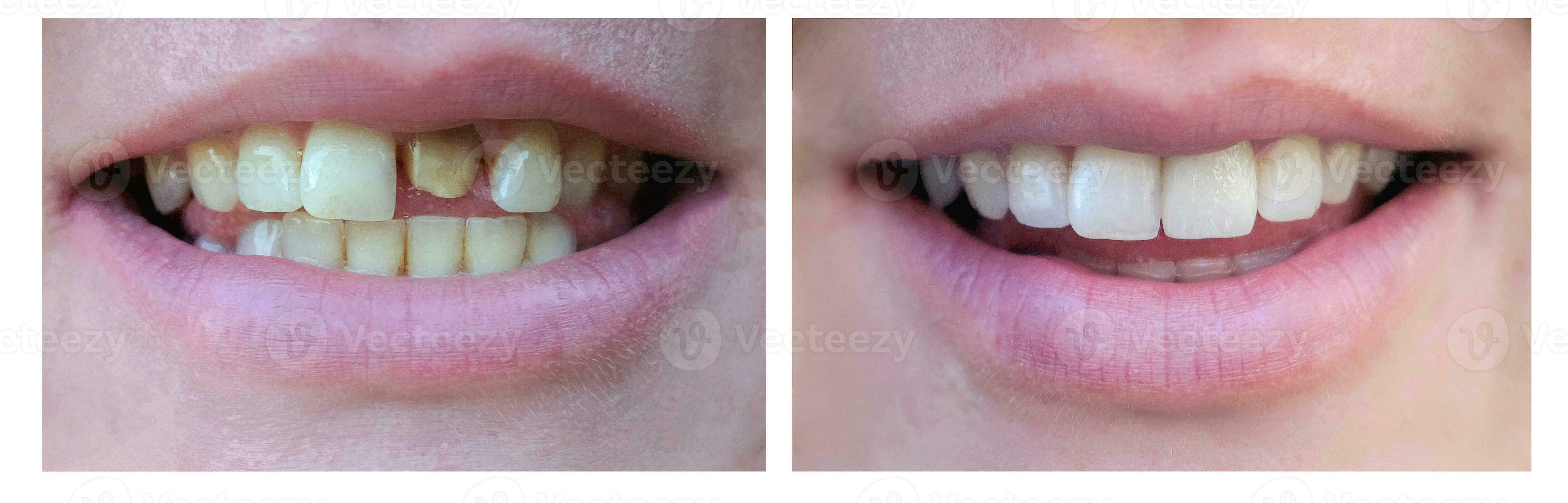 Smiling woman with a bad tooth before and after treatment. Closeup