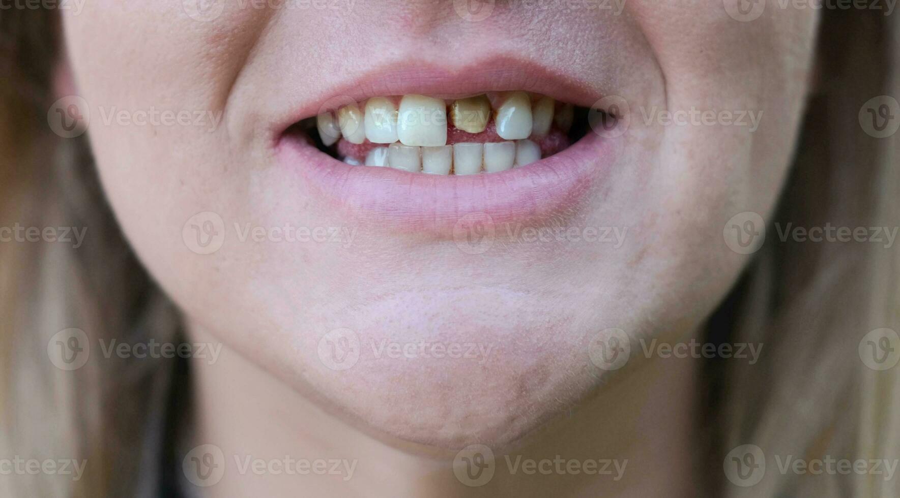 mujer sonrisa con un malo diente. dientes antes de tratamiento. de cerca. foto