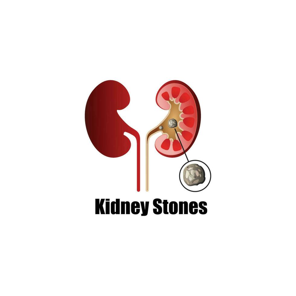 Human Kidney Stones, Kidney Inside, Kidney System, Bean shape, Vector illustration.