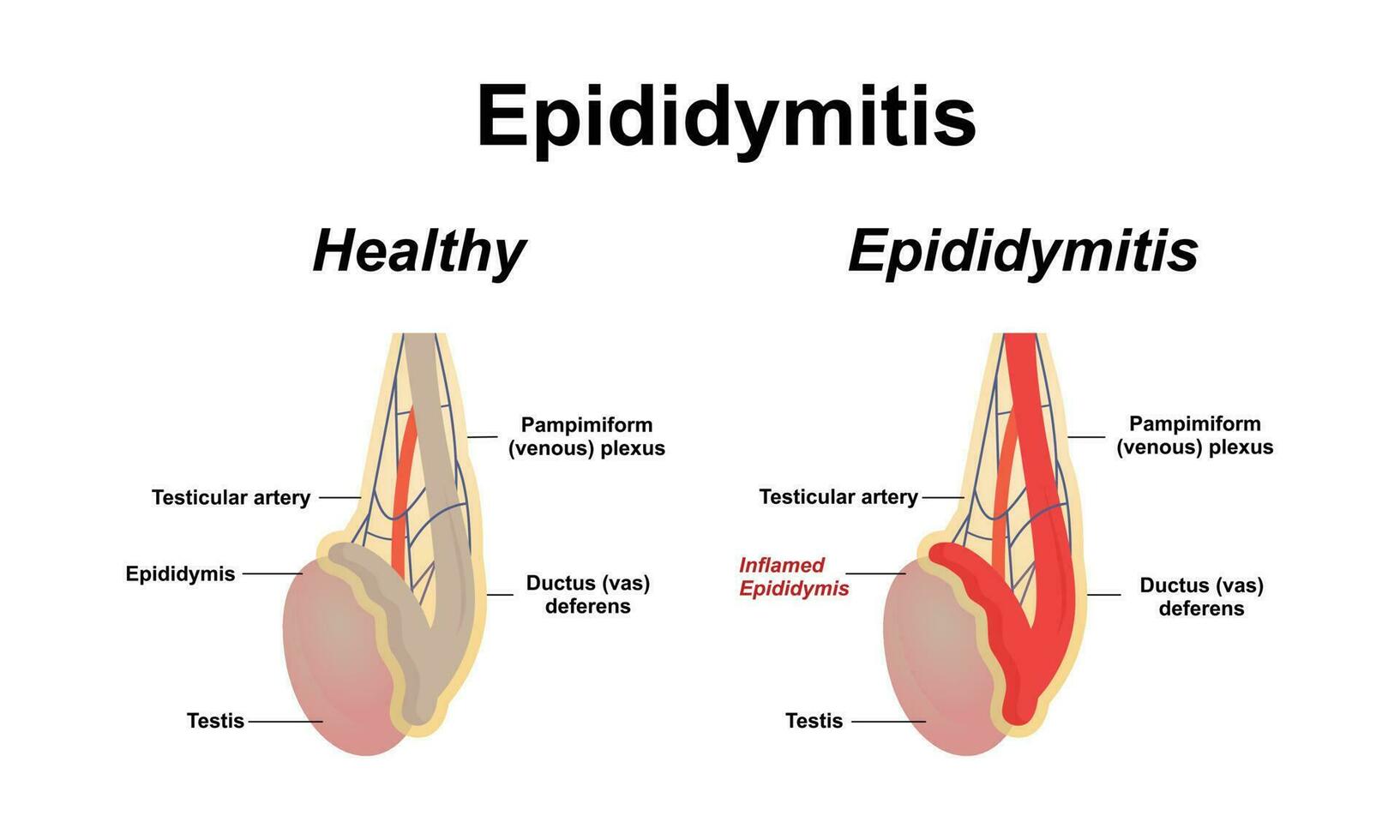 Epididymitis is inflammation of the epididymis of the testicle. vector