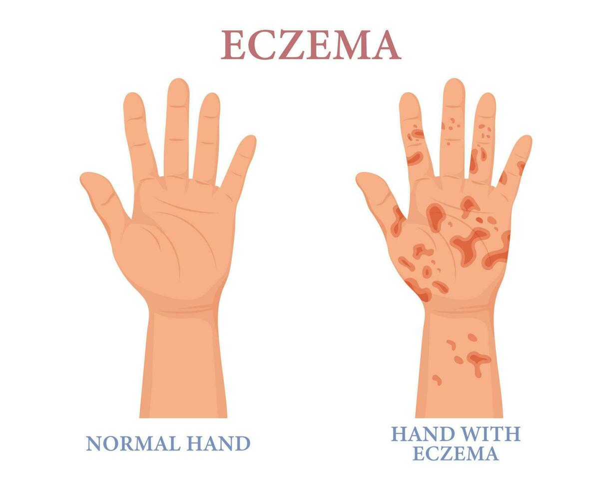 Eczema, healthy and unhealthy hand. Dermatology. The concept of medicine and healthcare. Poster, banner, vector