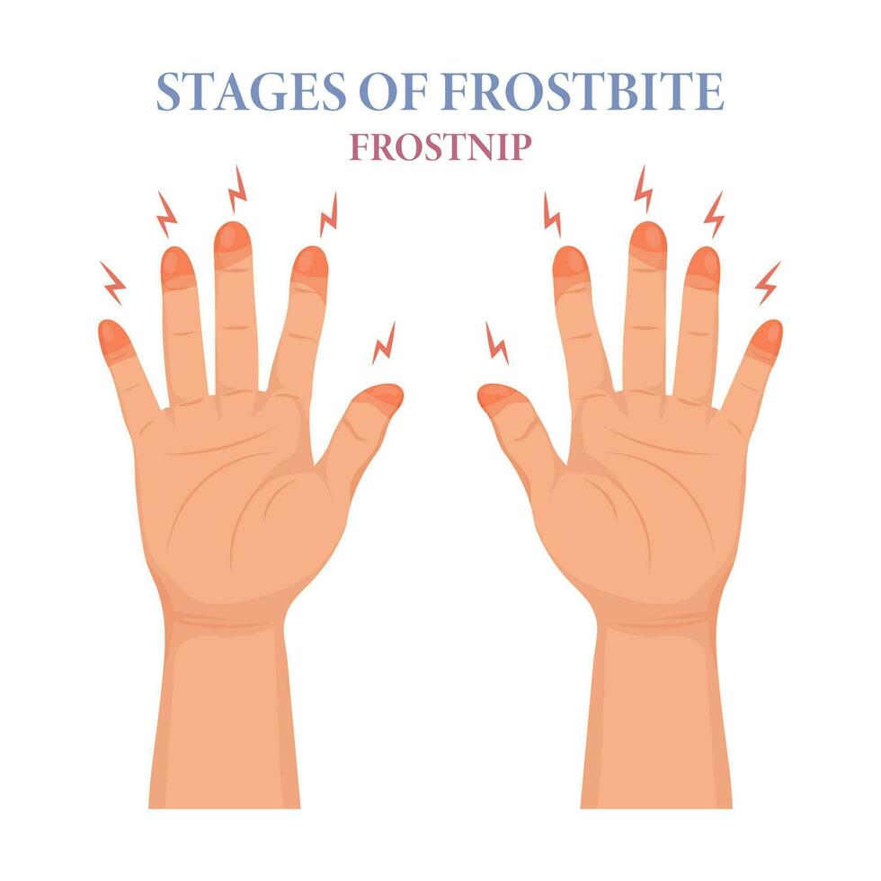 Frozen hands in different stages. Medical frostbite. Stages of frostbite of fingers. Skin burn symptom. Medical healthcare concept. Vector