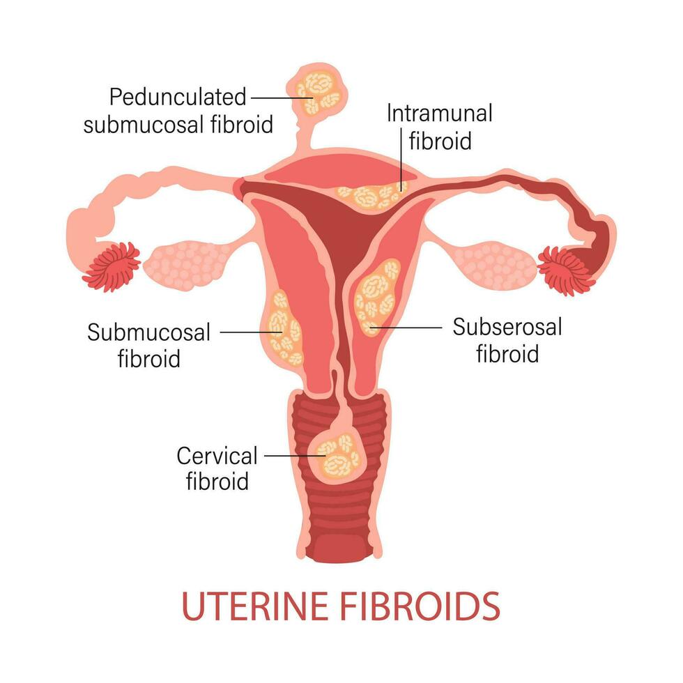 Types of uterine fibroids in women. Fibroids. Diseases of the female reproductive system. Healthy and unhealthy uterus. Gynecology. Medical concept. Infographic banner. Vector