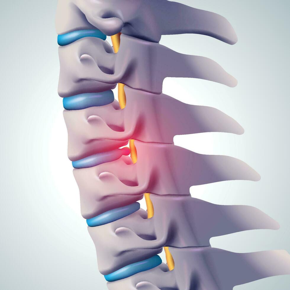 3D illustration. Herniated discs press on nerves causing pain. Medical. vector