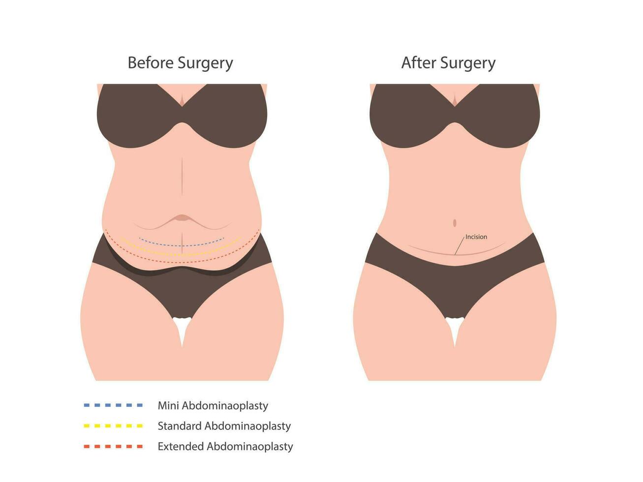 Abdominoplasty tummy tuck surgery. skin fat loss vector