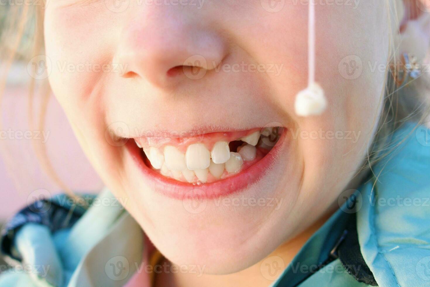 Child pulled out milk tooth with thread. photo