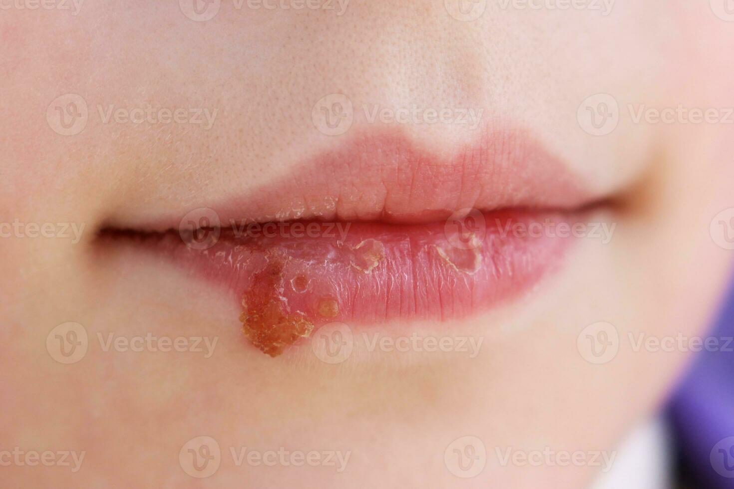 herpes en labios de niño. tratamiento ungüento. foto