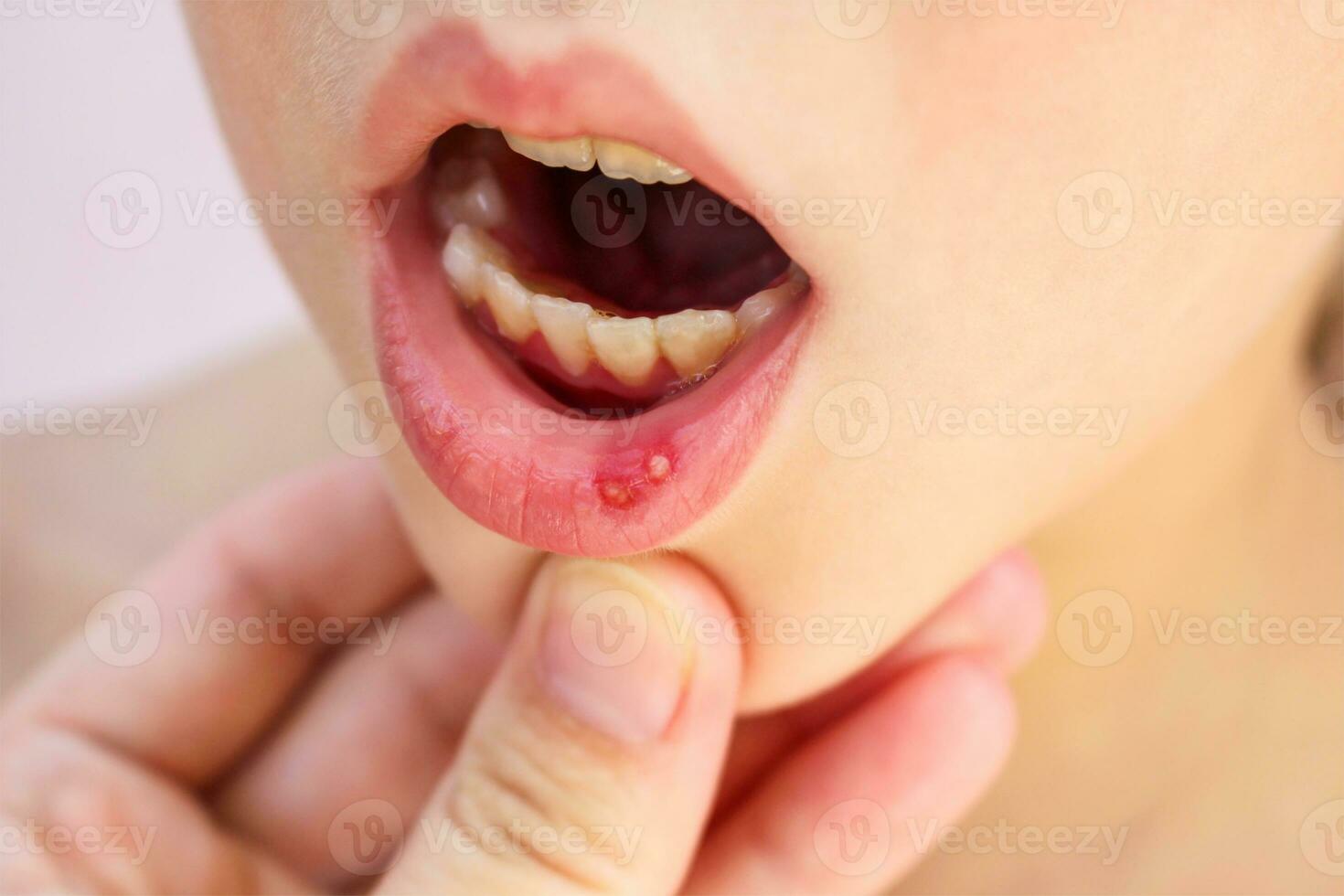 Stomatitis on lip in child photo