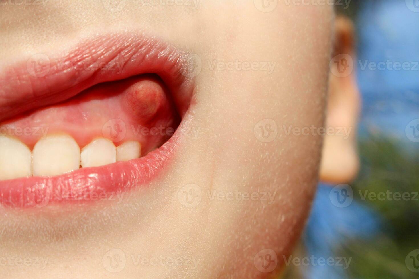 Swelling on gums the child. photo