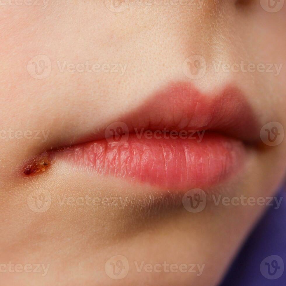Herpes on lips of child. photo