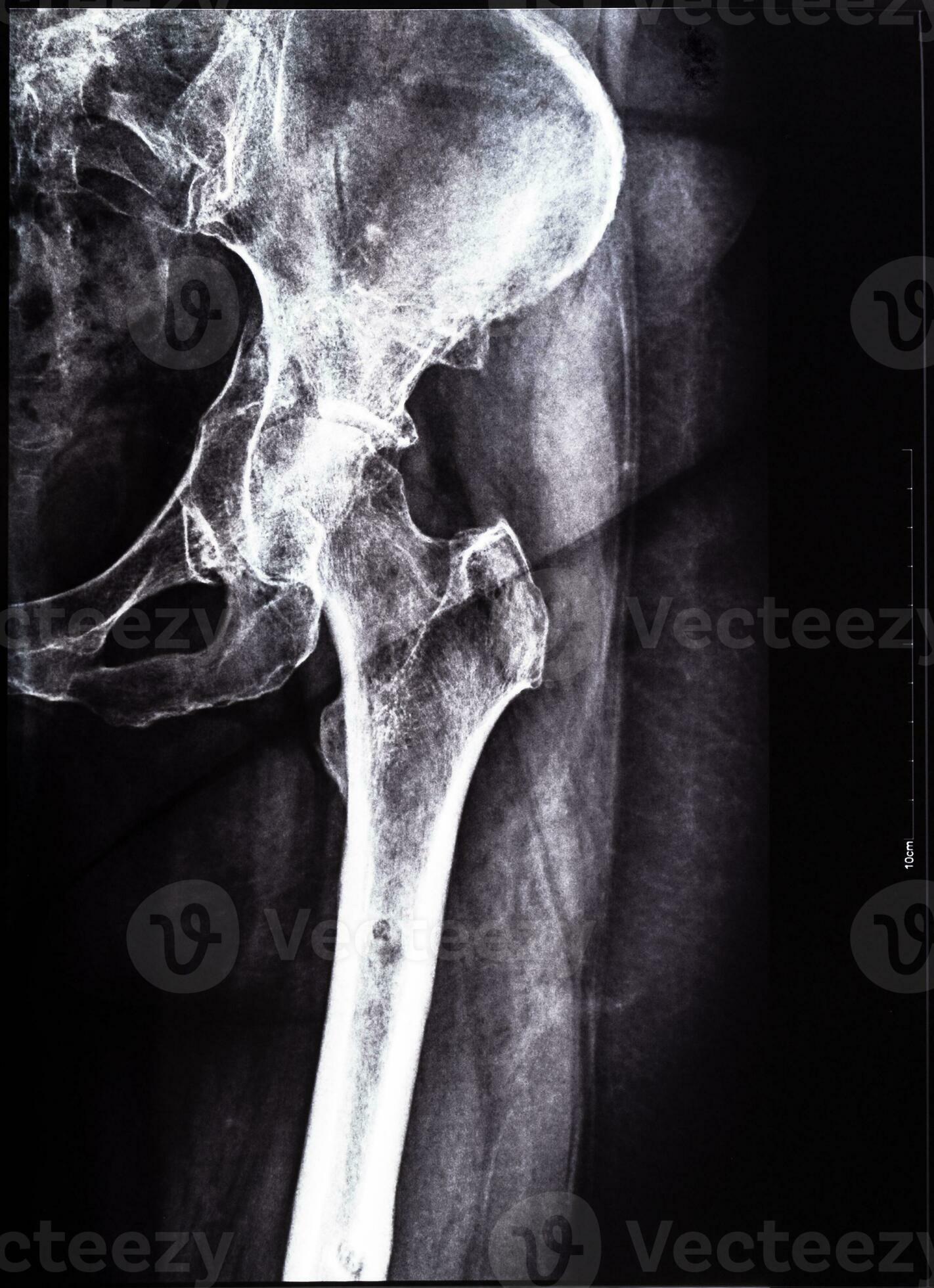 negative xray of junction of tibia and pelvis 24097642 Stock Photo at