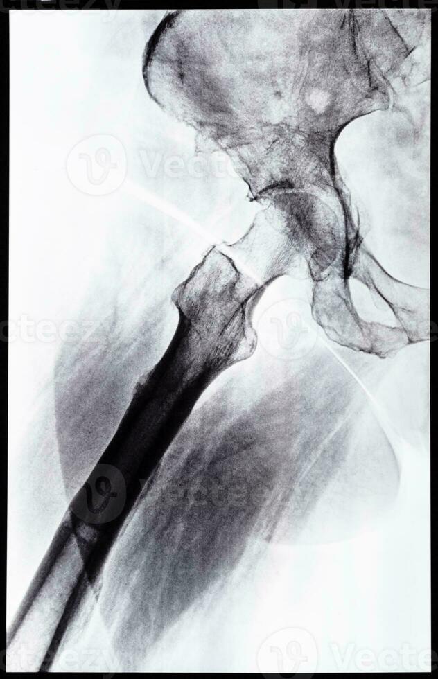 x-ray side view of junction of tibia and pelvis photo