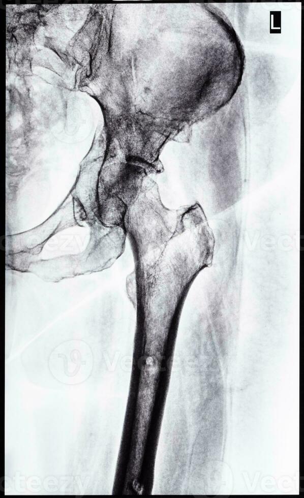 x-ray of junction of tibia and pelvis after healed photo