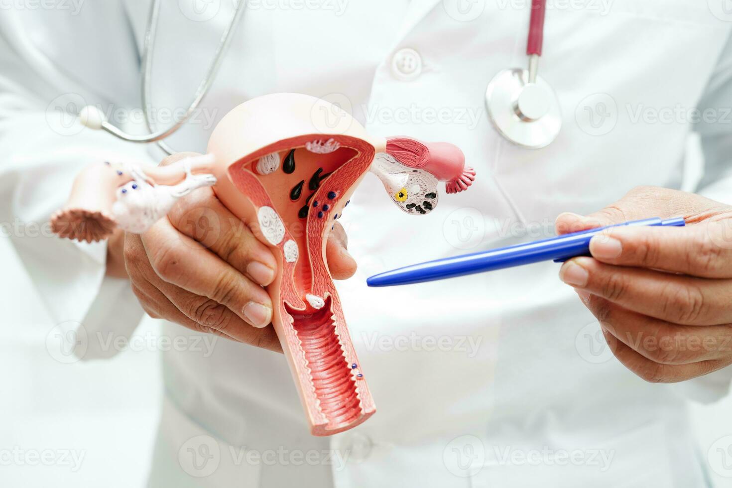 útero, médico participación anatomía modelo para estudiar diagnóstico y tratamiento en hospital. foto