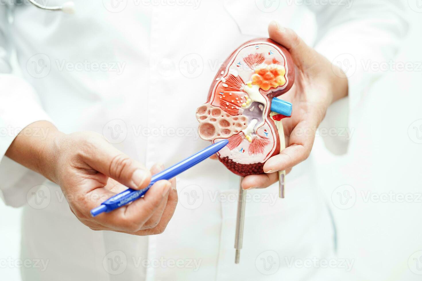 Chronic kidney disease, doctor holding model for treatment urinary system, urology, Estimated glomerular filtration rate eGFR. photo