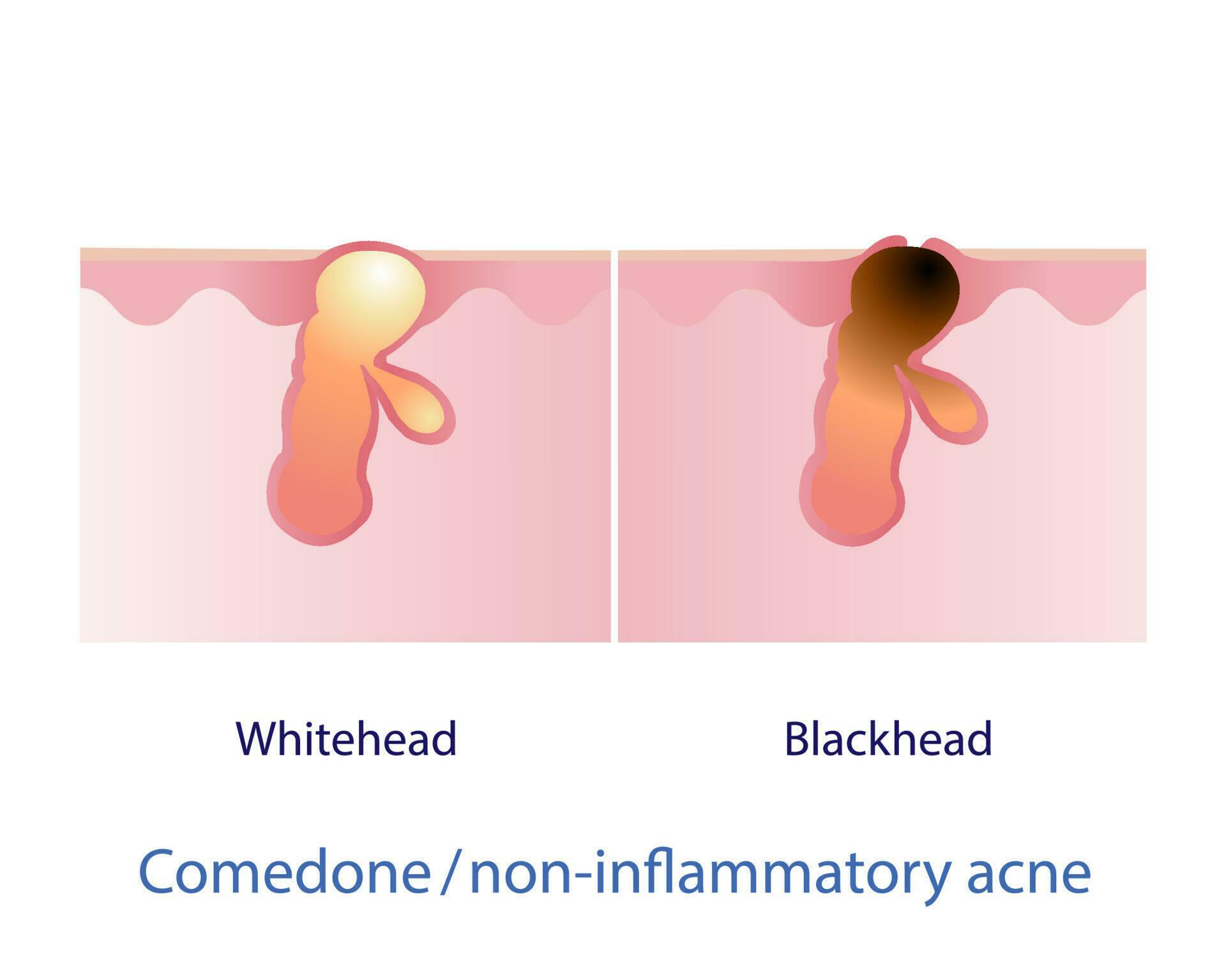 Types of comedone, non inflammatory acne vector on white background